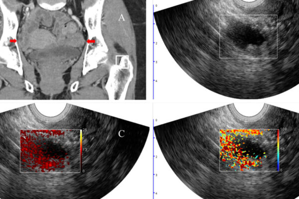 Photoacoustic imaging improves diagnostic accuracy of cancerous ovarian lesions